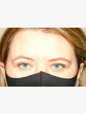 Upper Blepharoplasty Lids