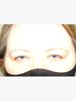 Upper Blepharoplasty Lids