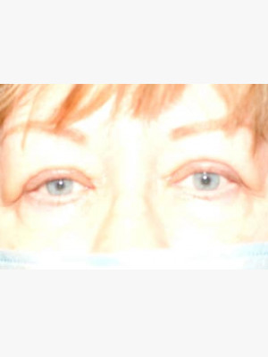 Upper Blepharoplasty Lids