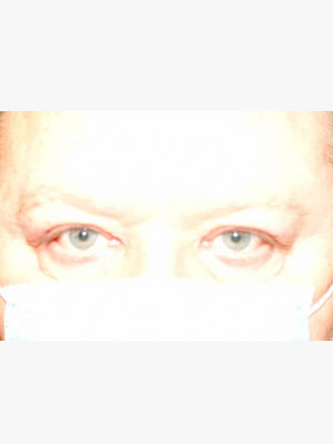 Upper Blepharoplasty Lids