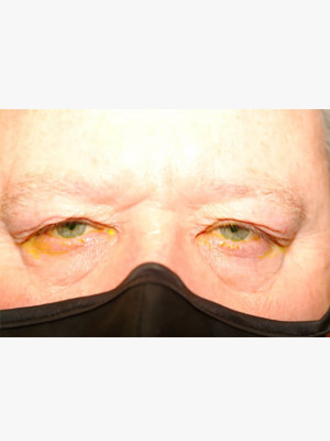 Upper Blepharoplasty Lids