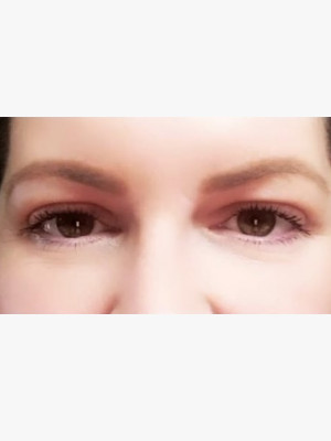 Upper Blepharoplasty Lids