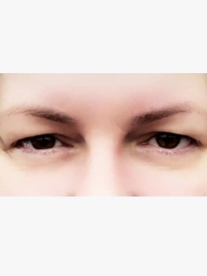 Upper Blepharoplasty Lids