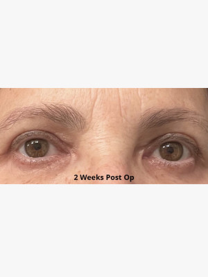 Upper Blepharoplasty Lids