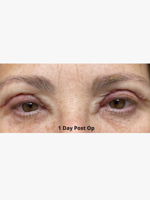 Upper Blepharoplasty Lids